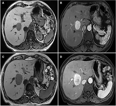 Case Report: A Malignant Liver and Thoracic Solitary Fibrous Tumor: A 10-Year Journey From the Brain to the Liver and the Spine